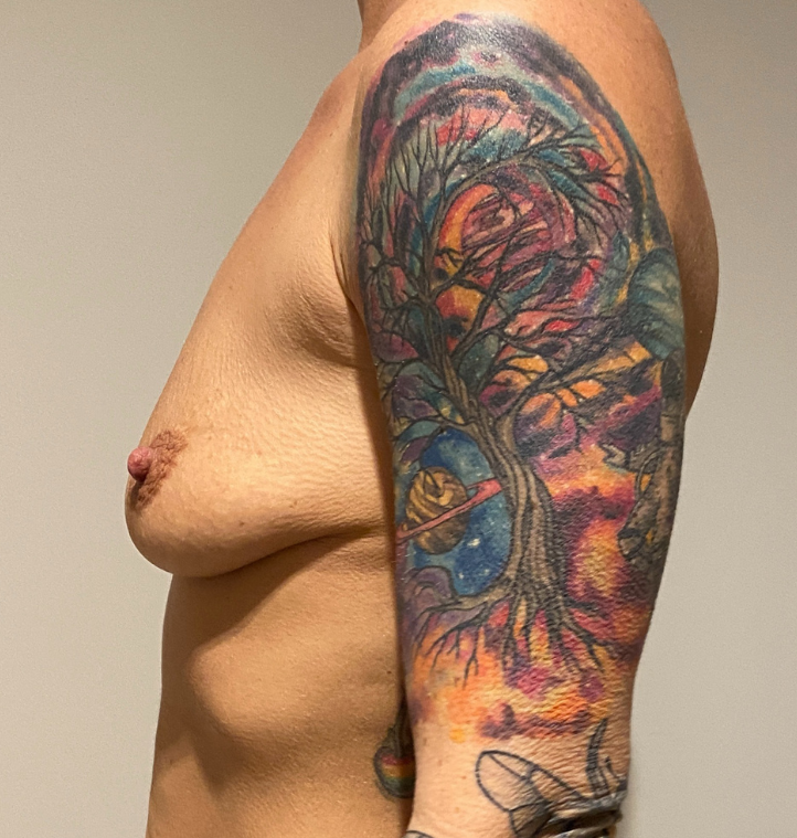 Before Image: Breast Augmentation - left-side