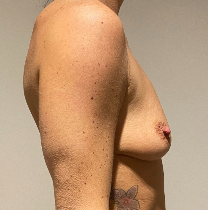 Before Image: Breast Augmentation - right-side