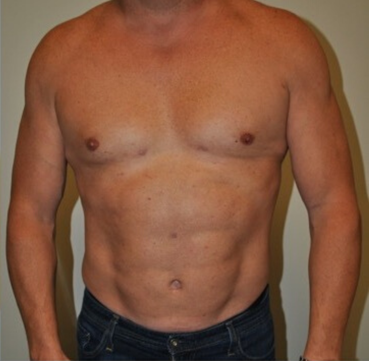 After Image: High Definition Liposuction - front
