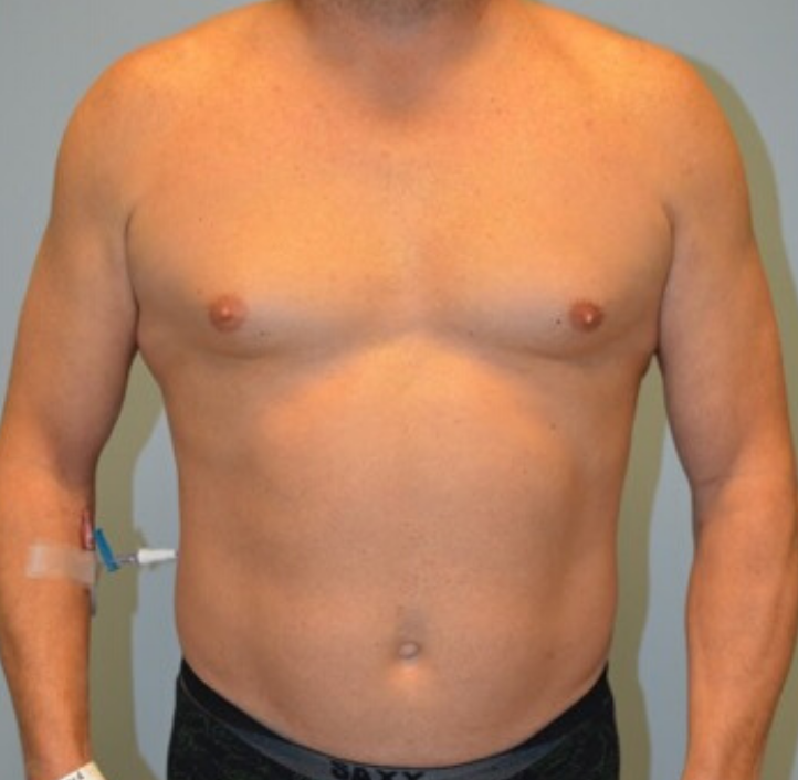 Before Image: High Definition Liposuction - front