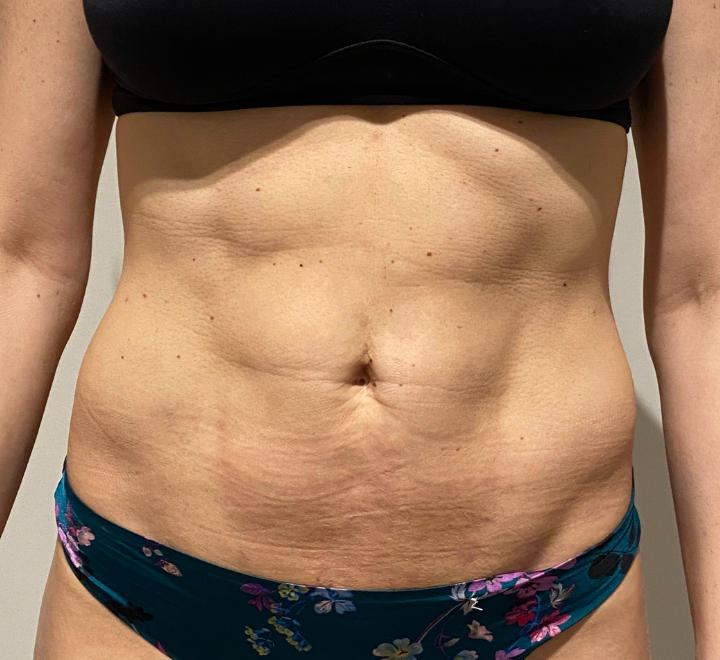 After Image: High Definition Liposuction - front