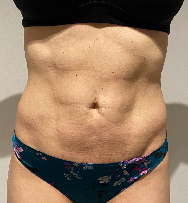 After Image: High Definition Liposuction - front
