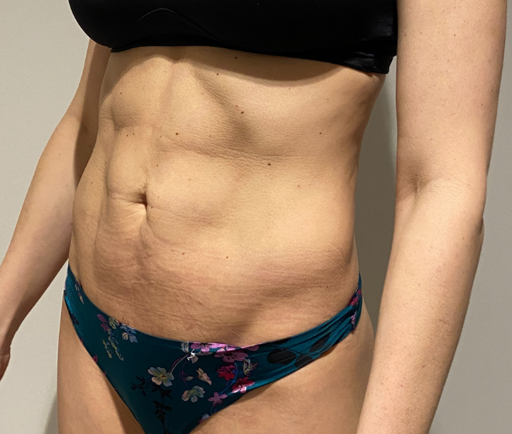 After Image: High Definition Liposuction - left-front-oblique