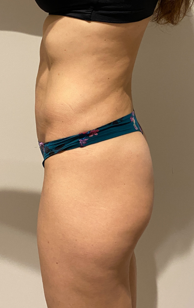 After Image: High Definition Liposuction - left-side