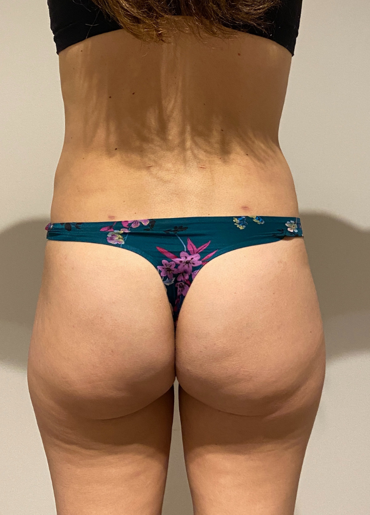 After Image: High Definition Liposuction - back