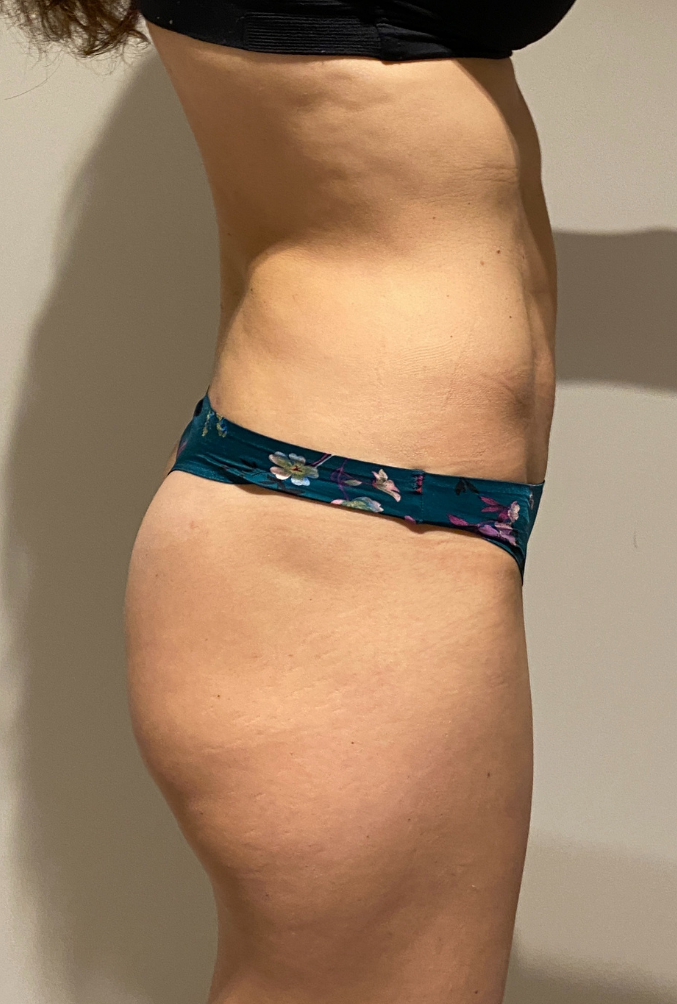 After Image: High Definition Liposuction - right-side