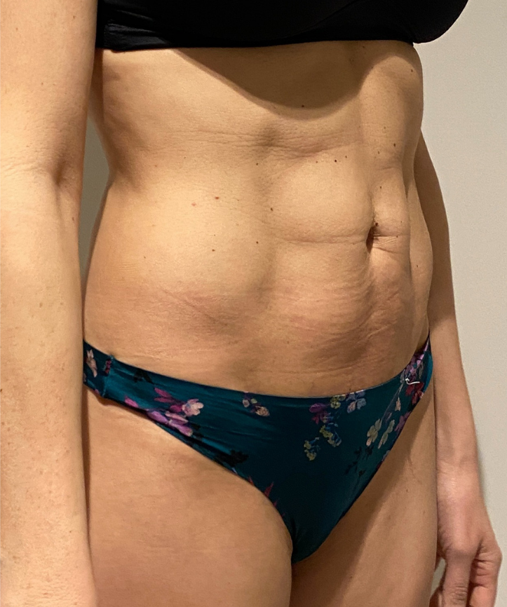 After Image: High Definition Liposuction - right-front-oblique