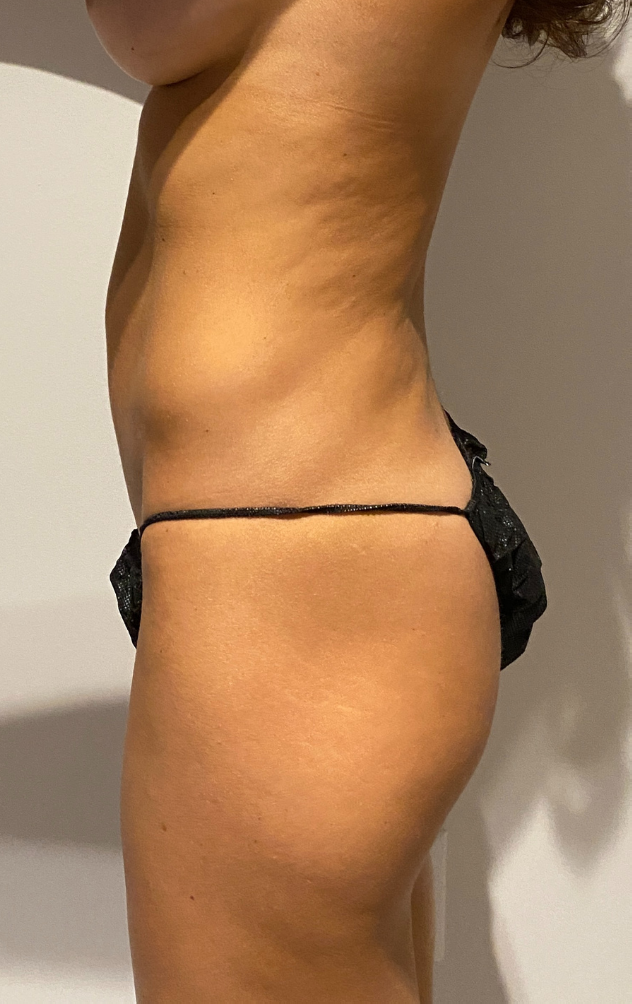 Before Image: High Definition Liposuction - left-side