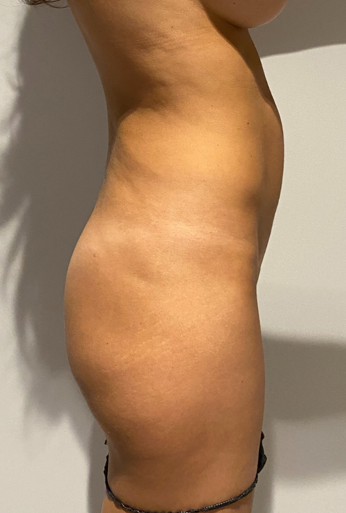 Before Image: High Definition Liposuction - right-side