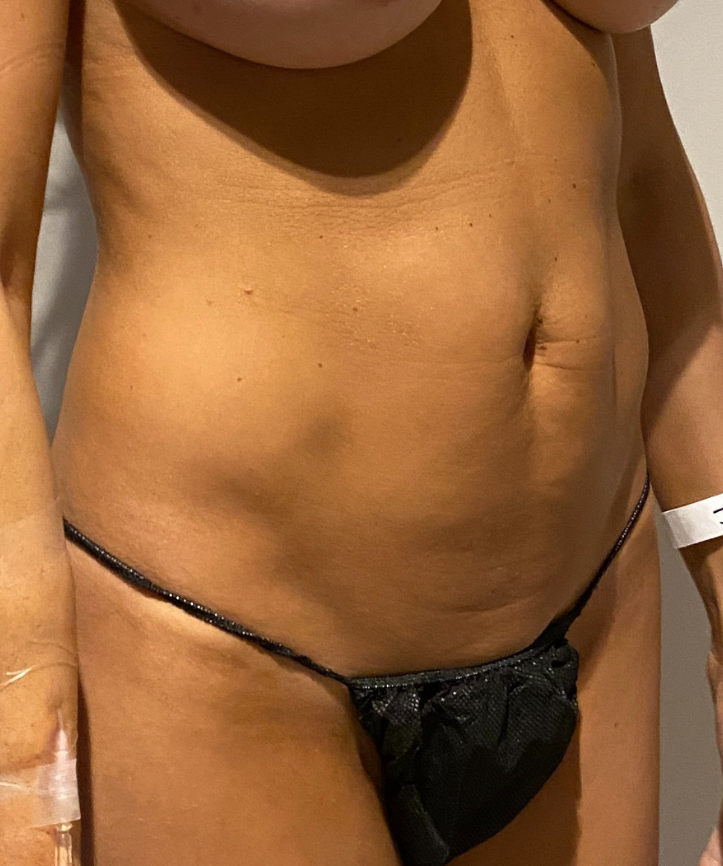 Before Image: High Definition Liposuction - right-front-oblique