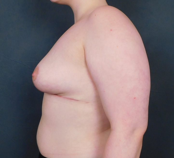 After Image: Breast Lift and Reduction - left-side