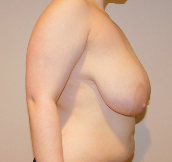 Before Image: Breast Lift and Reduction - right-side