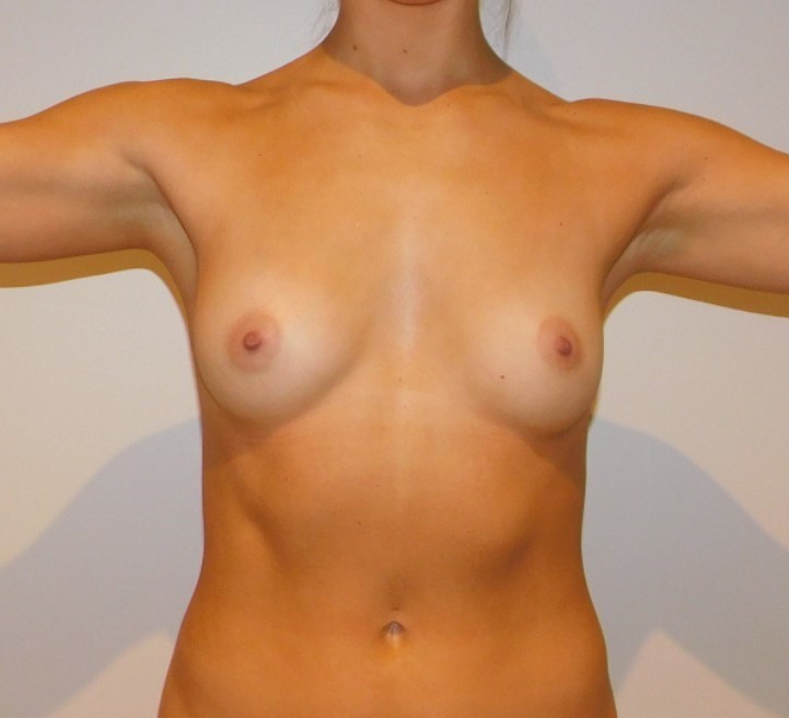 Before Image: Breast Augmentation - front