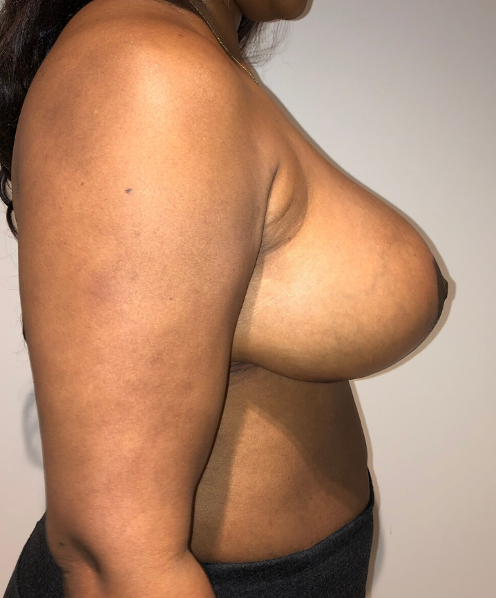 After Image: Breast Lift and Reduction - right-side