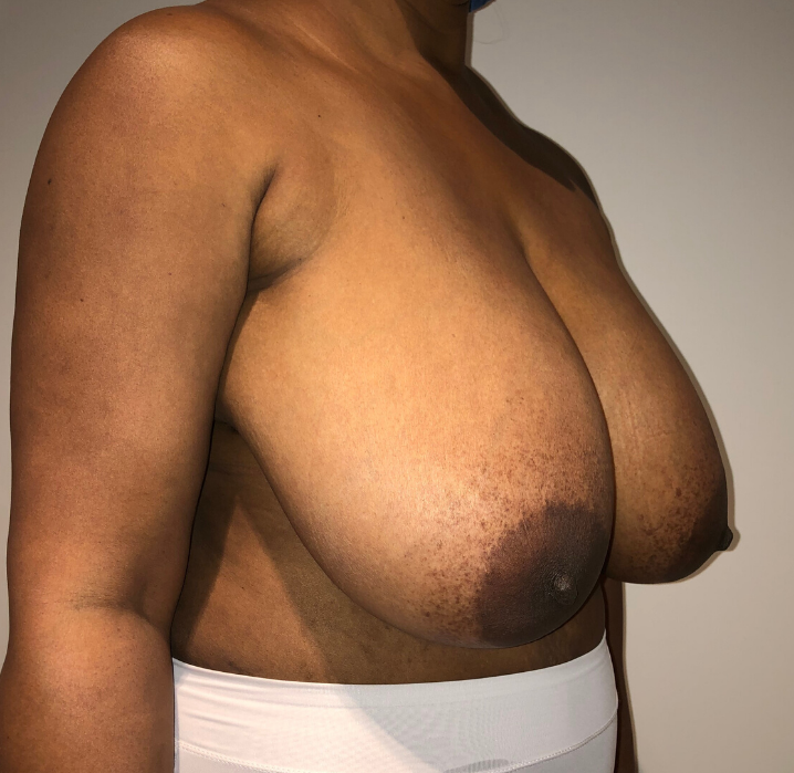 Before Image: Breast Lift and Reduction - right-front-oblique
