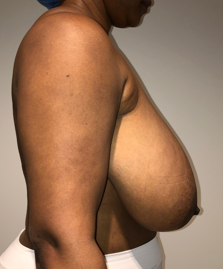 Before Image: Breast Lift and Reduction - right-side