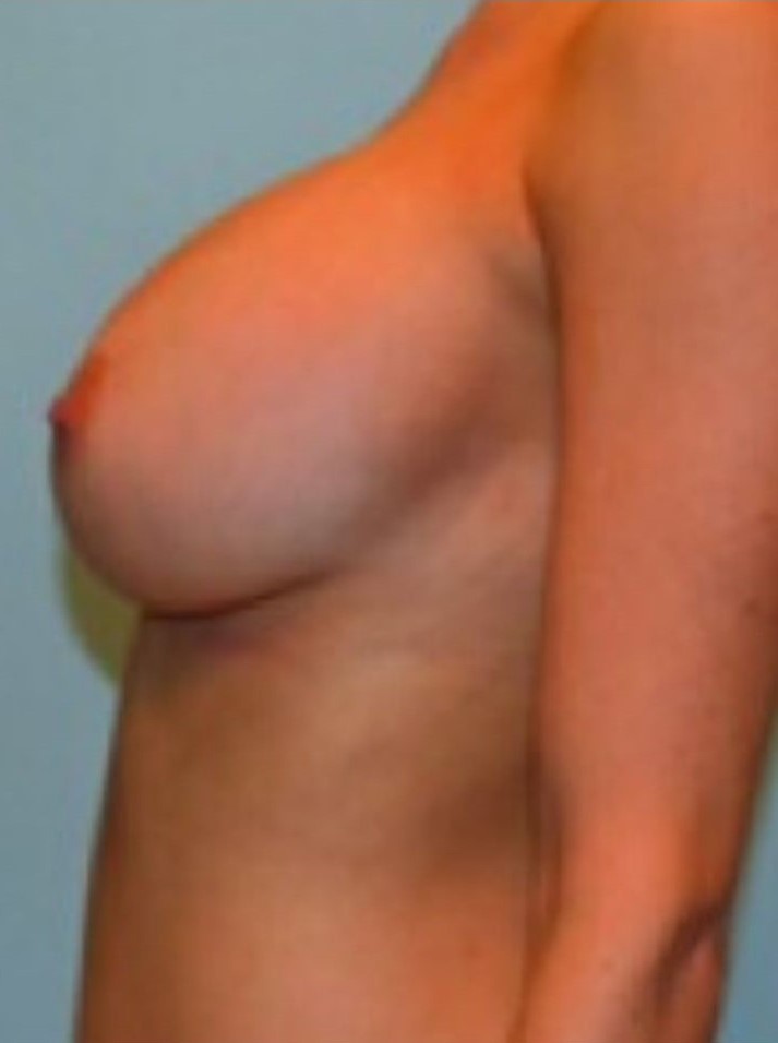After Image: Breast Augmentation - left-side
