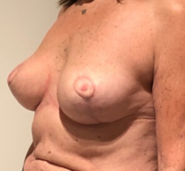 After Image: Breast Lift and Reduction - left-front-oblique