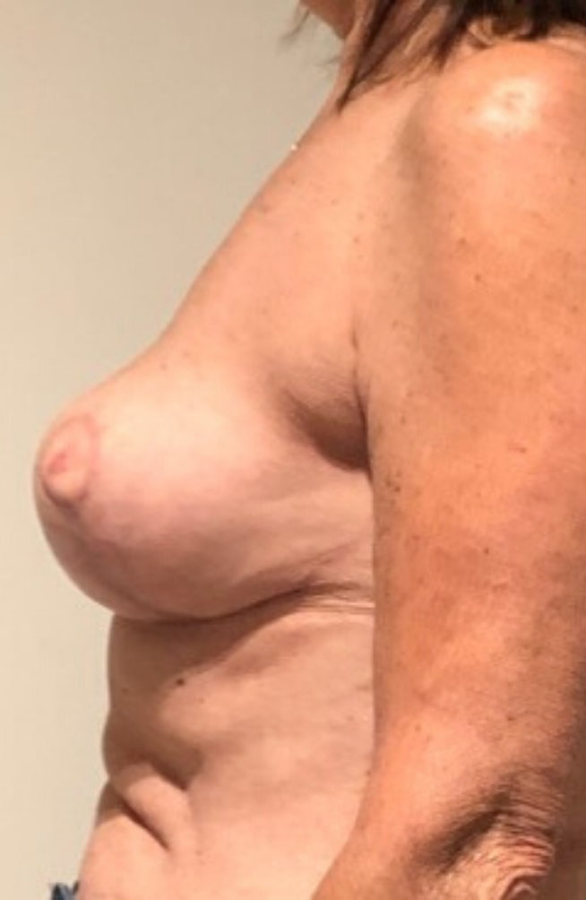 After Image: Breast Lift and Reduction - left-side