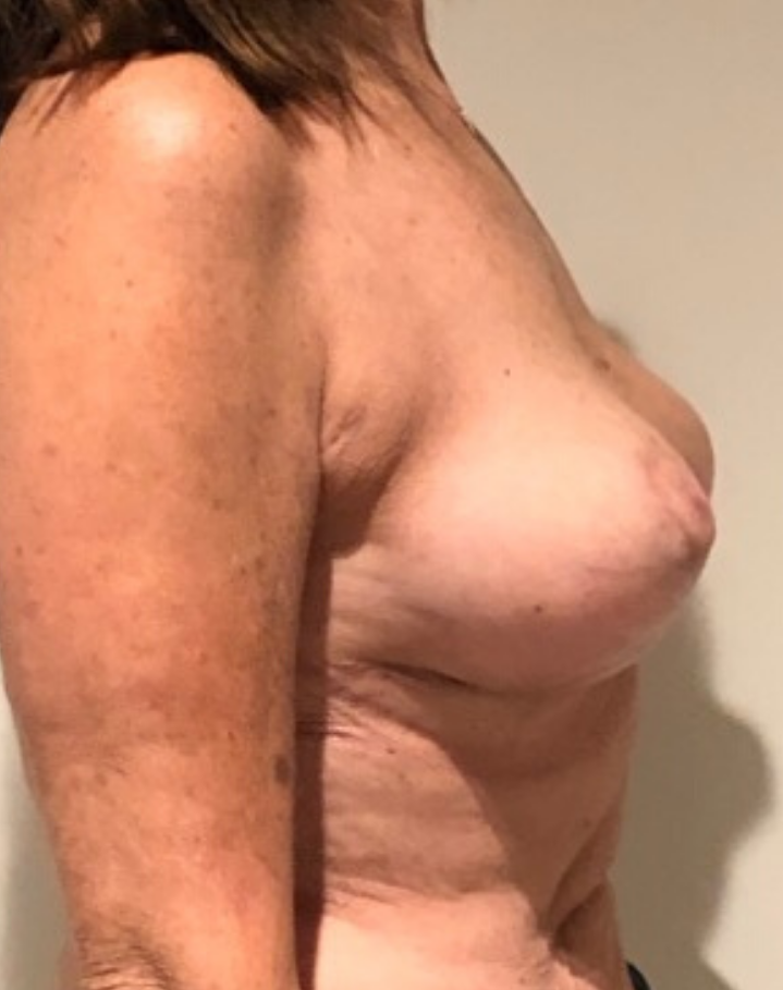 After Image: Breast Lift and Reduction - right-side