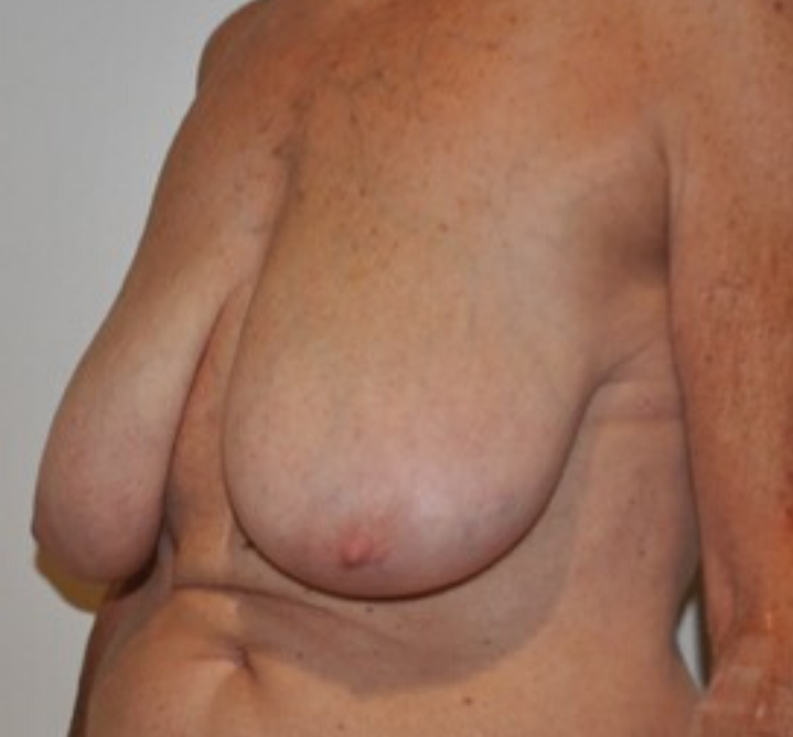 Before Image: Breast Lift and Reduction - left-front-oblique