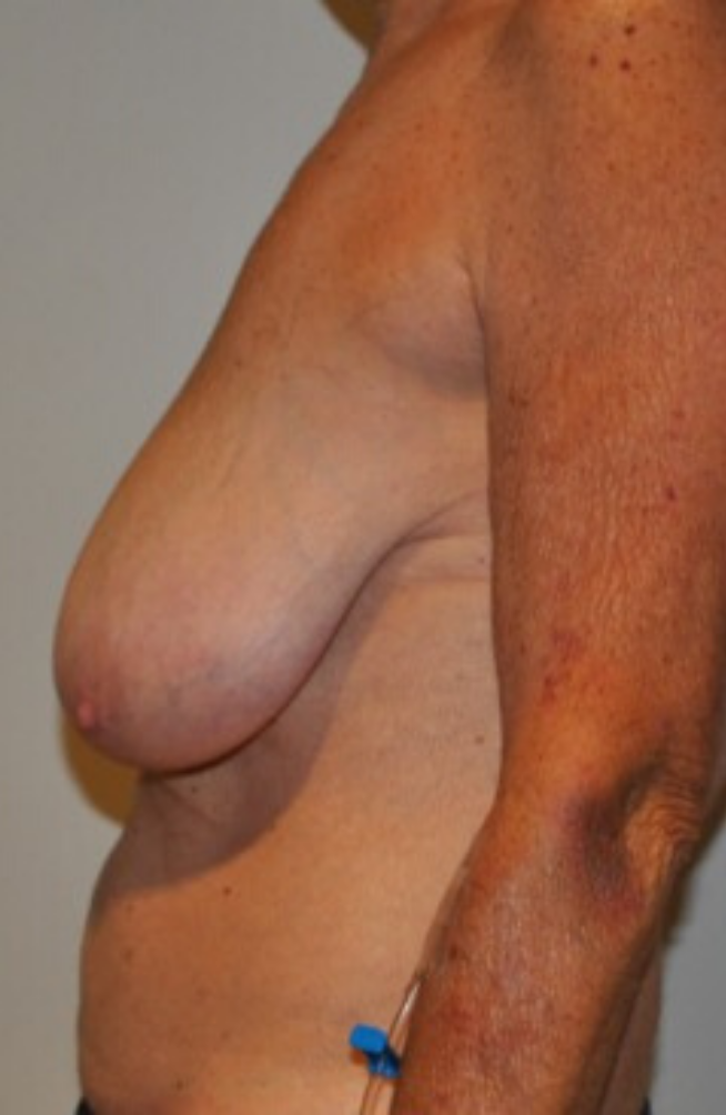 Before Image: Breast Lift and Reduction - left-side