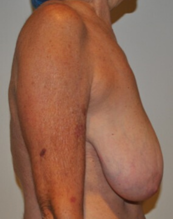 Before Image: Breast Lift and Reduction - right-side