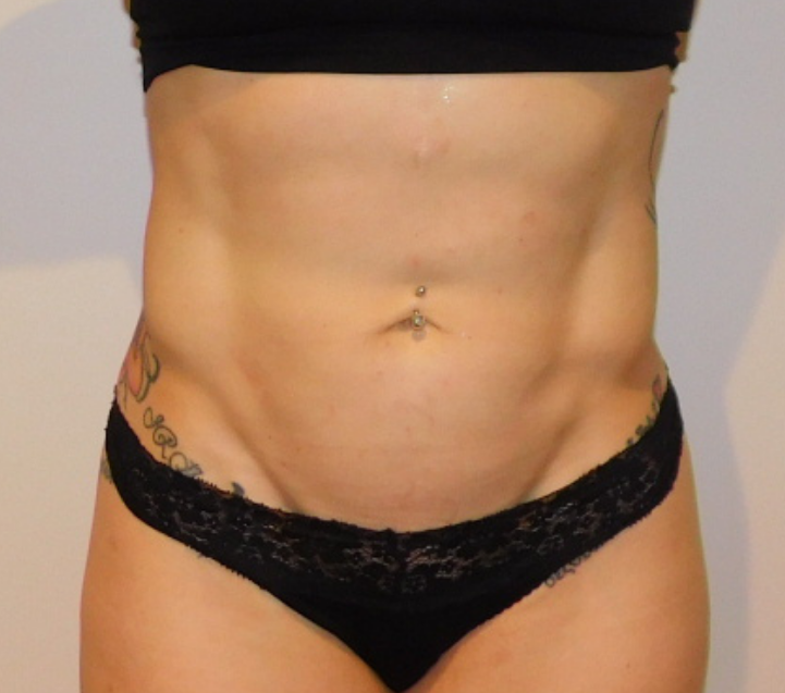 After Image: High Definition Liposuction - front
