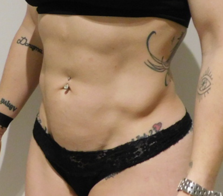 After Image: High Definition Liposuction - left-front-oblique
