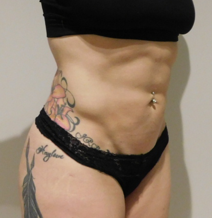After Image: High Definition Liposuction - right-front-oblique