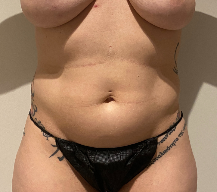 Before Image: High Definition Liposuction - front