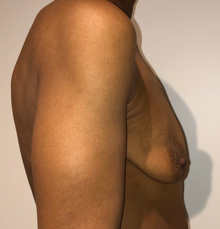 Before Image: Breast Lift and Reduction - right-side