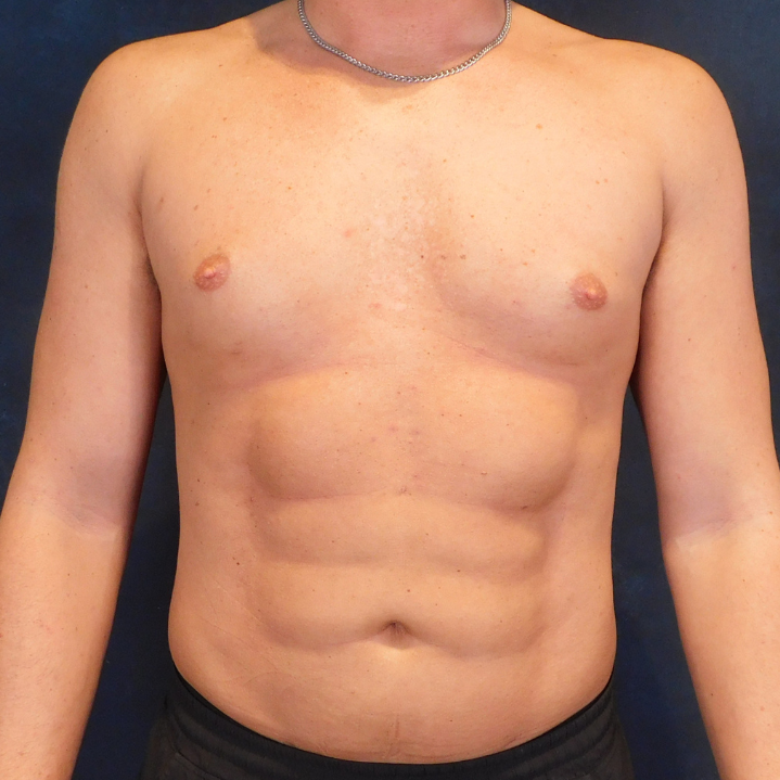After Image: High Definition Liposuction - front