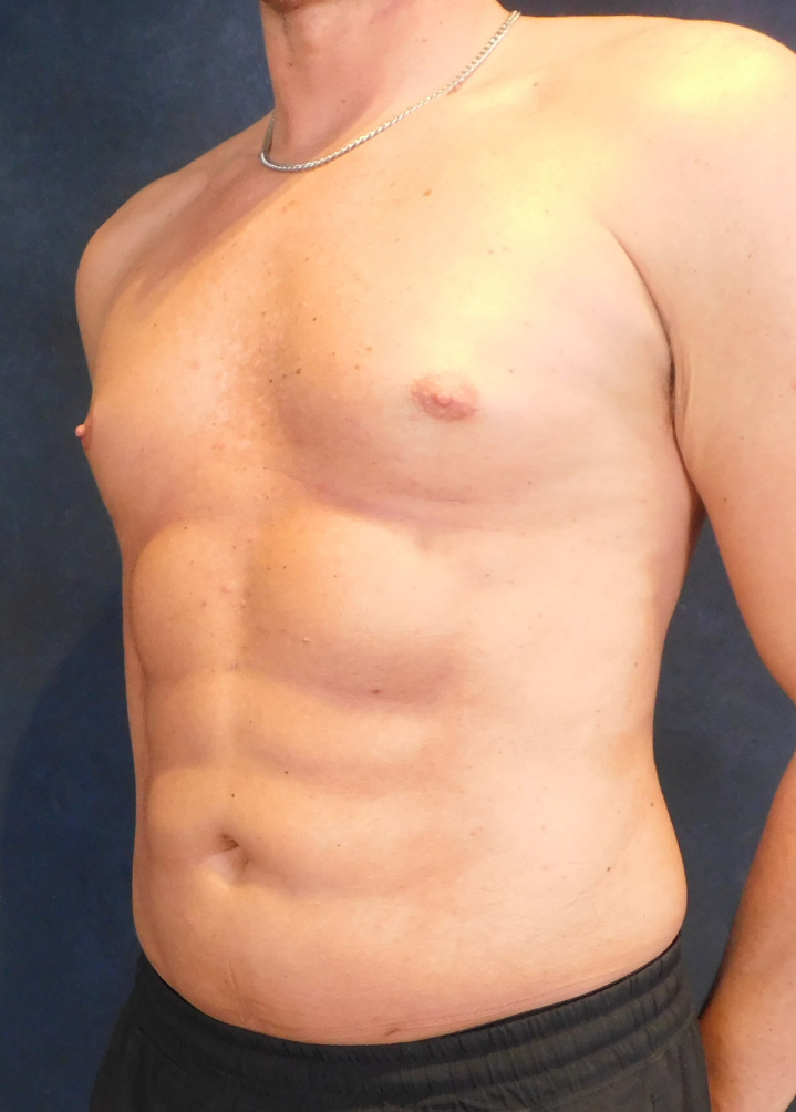 After Image: High Definition Liposuction - left-front-oblique