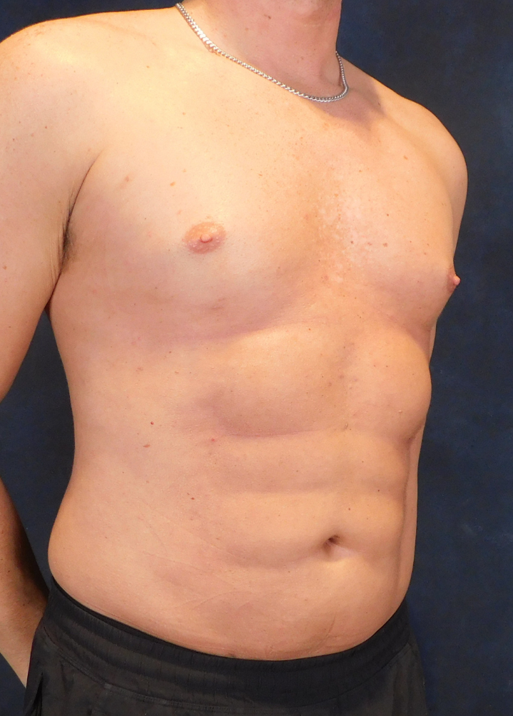 After Image: High Definition Liposuction - right-front-oblique
