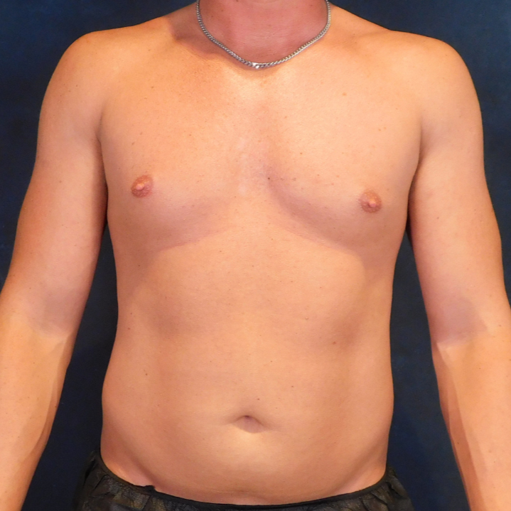 Before Image: High Definition Liposuction - front