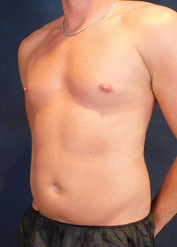 Before Image: High Definition Liposuction - left-front-oblique