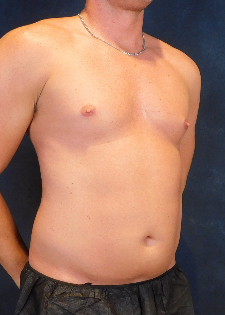Before Image: High Definition Liposuction - right-front-oblique