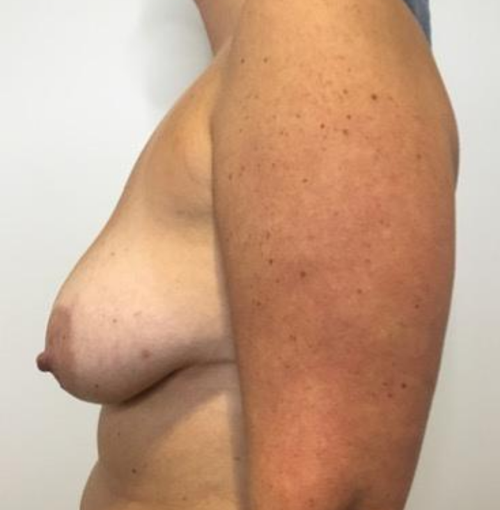 Before Image: Breast Lift and Reduction - left-side