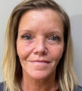 After Image: Blepharoplasty