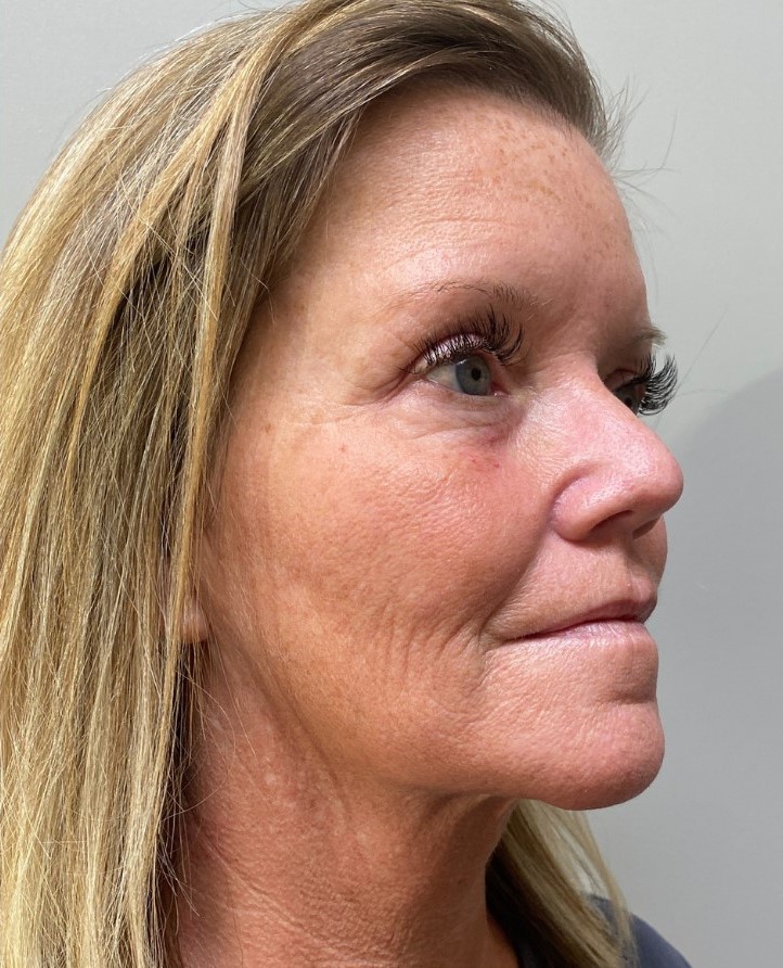 After Image: Blepharoplasty - right-front-oblique