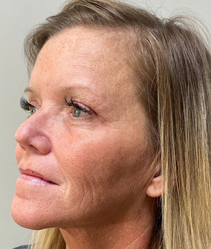 After Image: Blepharoplasty - left-front-oblique