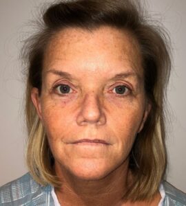Before Image: Blepharoplasty