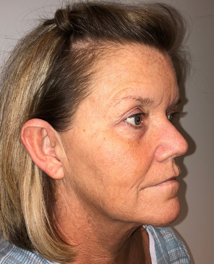 Before Image: Blepharoplasty - right-front-oblique