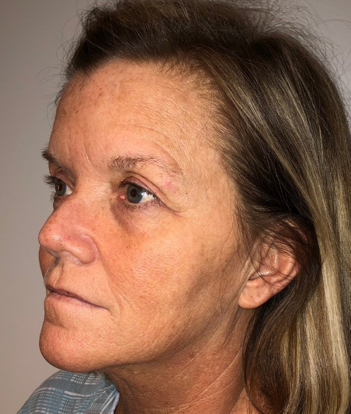 Before Image: Blepharoplasty - left-front-oblique