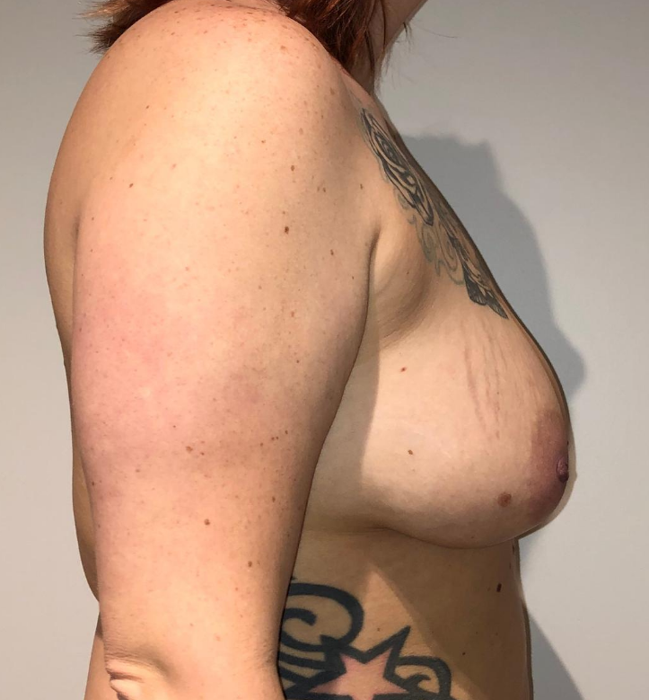 Before Image: Breast Lift and Reduction - right-side