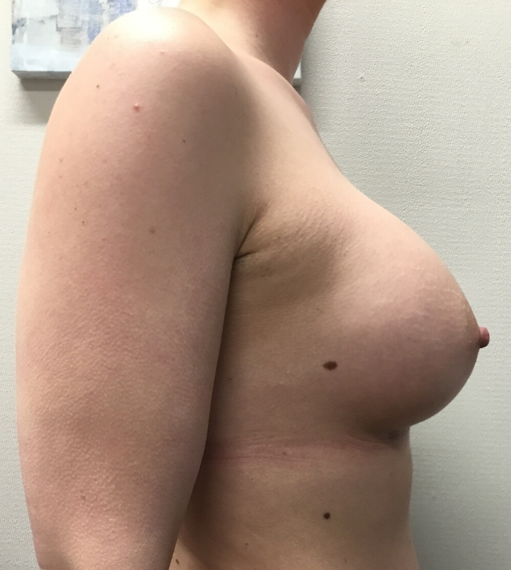 After Image: Breast Augmentation - right-side