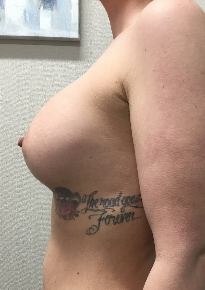 After Image: Breast Augmentation - left-side