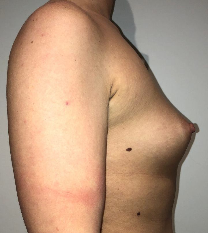 Before Image: Breast Augmentation - right-side