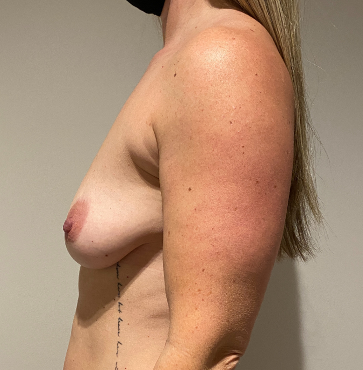 Before Image: Breast Lift and Reduction - left-side